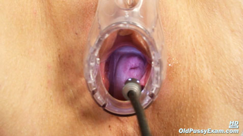 granny cervix closeup